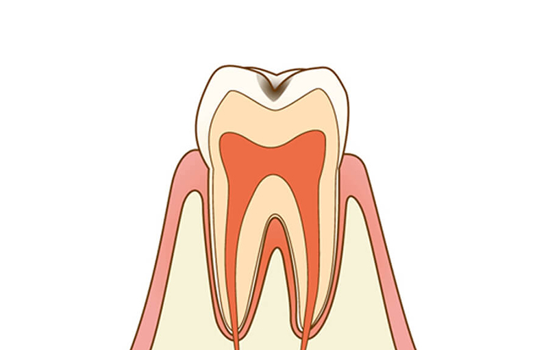 エナメル質内の虫歯