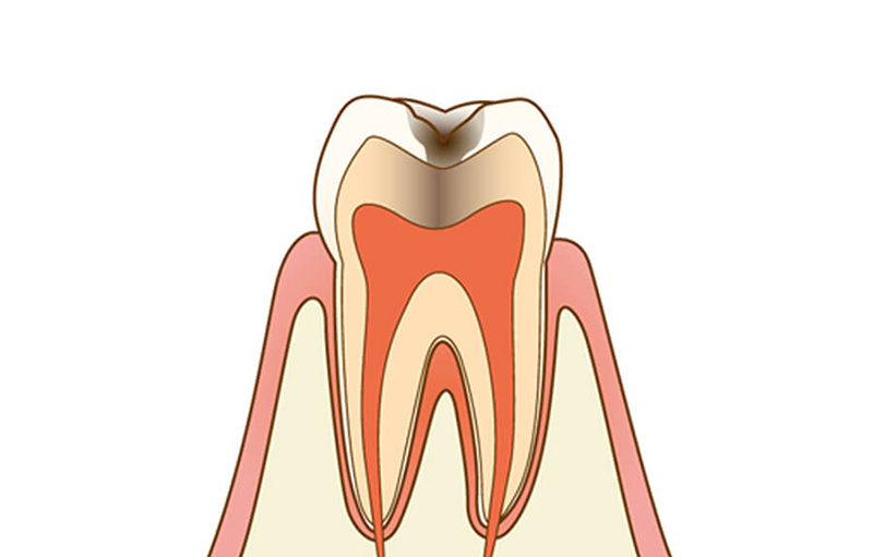 象牙質に達した虫歯