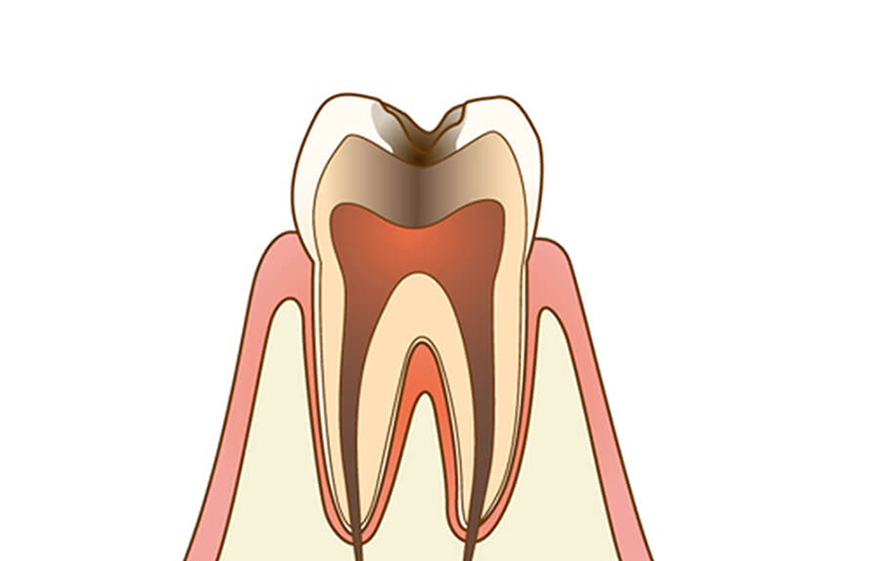 歯髄(神経)に達した虫歯