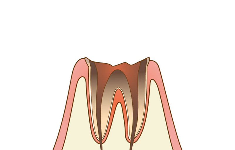 歯質が失われた虫歯