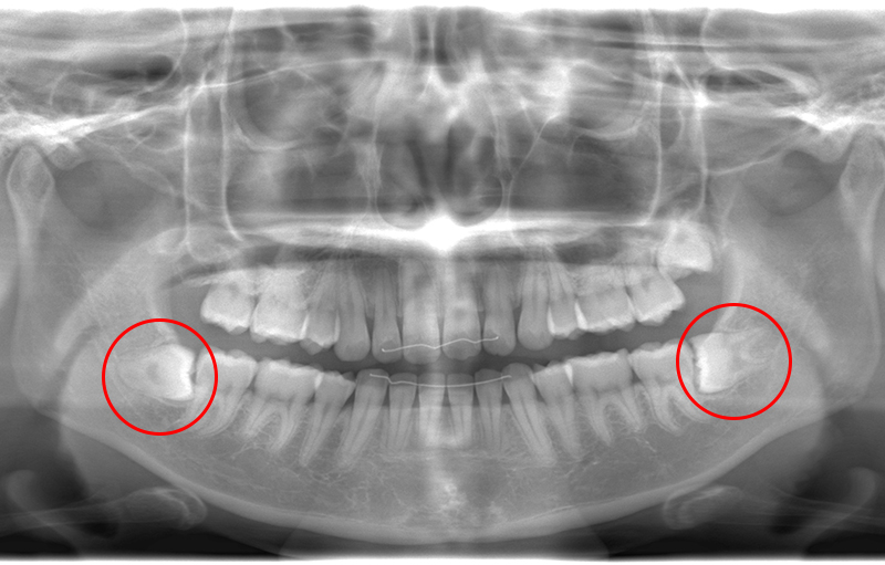 親知らずの症例