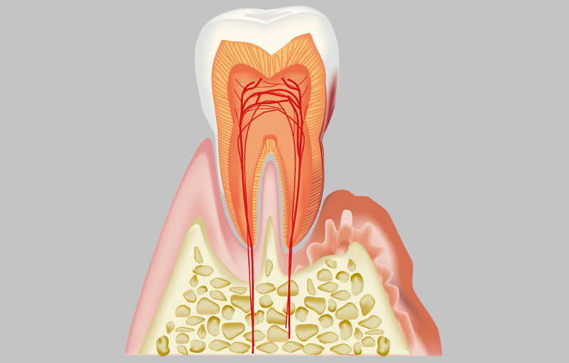 軽度歯周炎（歯周ポケット4〜6mmの状態）