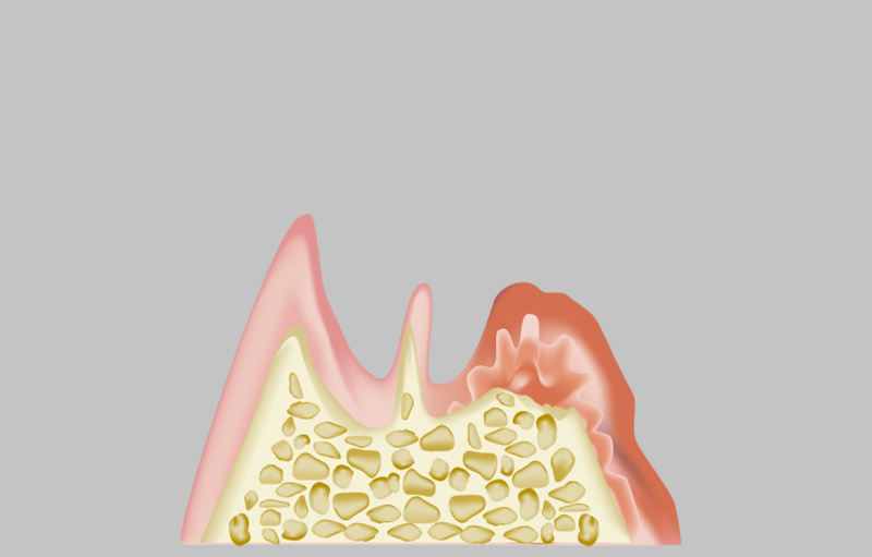 重度歯周炎（歯槽膿漏）